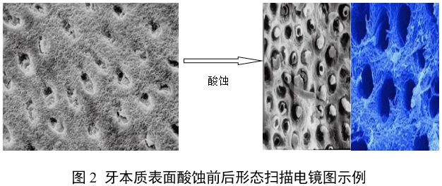 牙科用磷酸酸蝕劑注冊(cè)審查指導(dǎo)原則(2022年第41號(hào))(圖2) 牙科用磷酸酸蝕劑注冊(cè)審查指導(dǎo)原則(2022年第41號(hào))(圖2)