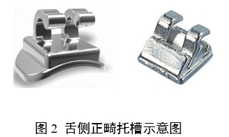 正畸托槽注冊審查指導原則(2022年第41號)(圖2) 正畸托槽注冊審查指導原則(2022年第41號)(圖2)