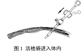 一次性使用內(nèi)窺鏡用活檢袋注冊審查指導(dǎo)原則(2025年第20號)(圖1) 一次性使用內(nèi)窺鏡用活檢袋注冊審查指導(dǎo)原則(2025年第20號)(圖1)