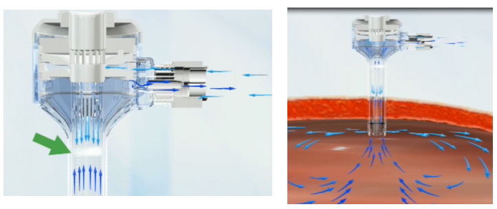 一次性使用腹部穿刺器注冊審查指導原則(2021年第103號)(圖2) 一次性使用腹部穿刺器注冊審查指導原則(2021年第103號)(圖2)