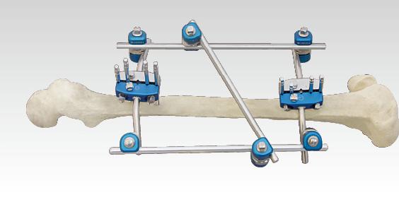 骨科外固定支架注冊(cè)技術(shù)審查指導(dǎo)原則(2018年修訂)(2018年第107號(hào))(圖1) 骨科外固定支架注冊(cè)技術(shù)審查指導(dǎo)原則(2018年修訂)(2018年第107號(hào))(圖1)
