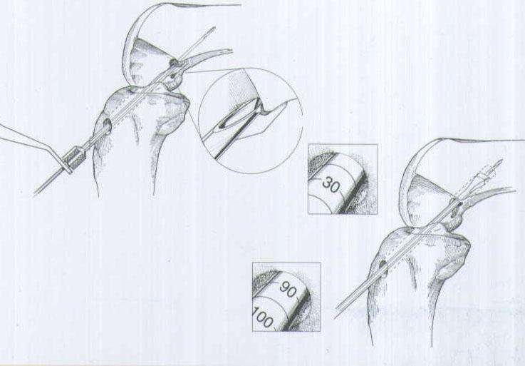 肌腱韌帶固定系統(tǒng)注冊(cè)技術(shù)審查指導(dǎo)原則(2020年第36號(hào))(圖1) 肌腱韌帶固定系統(tǒng)注冊(cè)技術(shù)審查指導(dǎo)原則(2020年第36號(hào))(圖1)